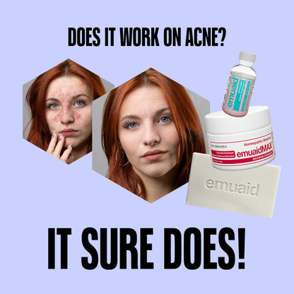 Promotional graphic for emuaid products with a before-and-after comparison of acne on a purple background.