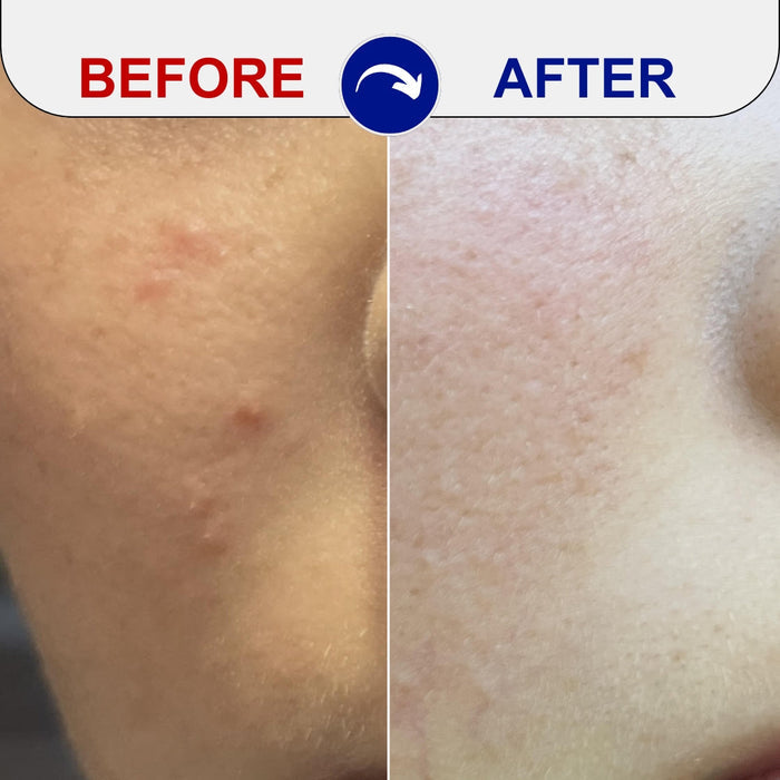 before and after acne treatment comparison
