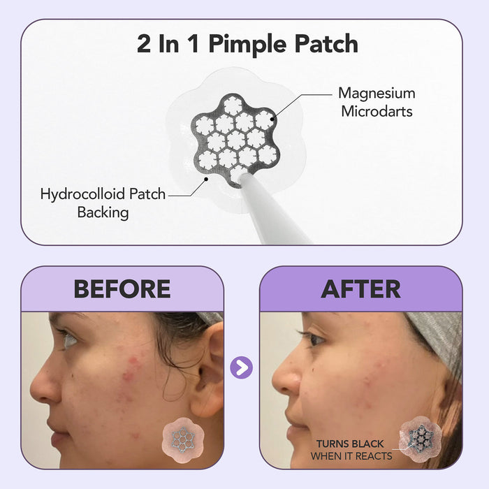 Freego Magnesium Microdarts Pimple Patch