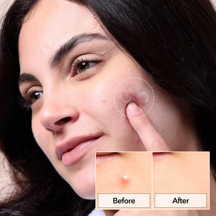 Freego Spot Pimple Patch