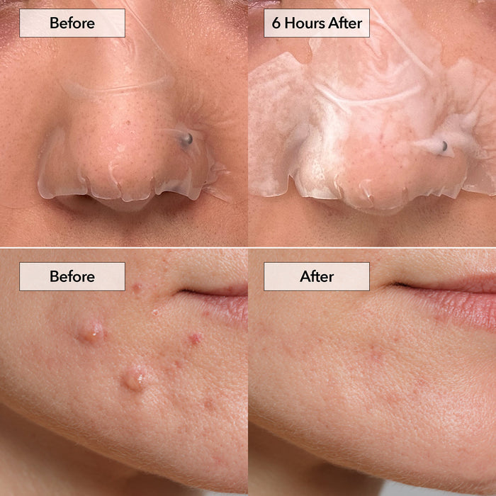 Freego Spot Pimple & Pore Patch