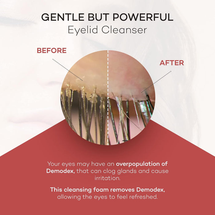 ZocuFoam™ Eyelid Cleanser